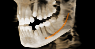 Cost of implant software